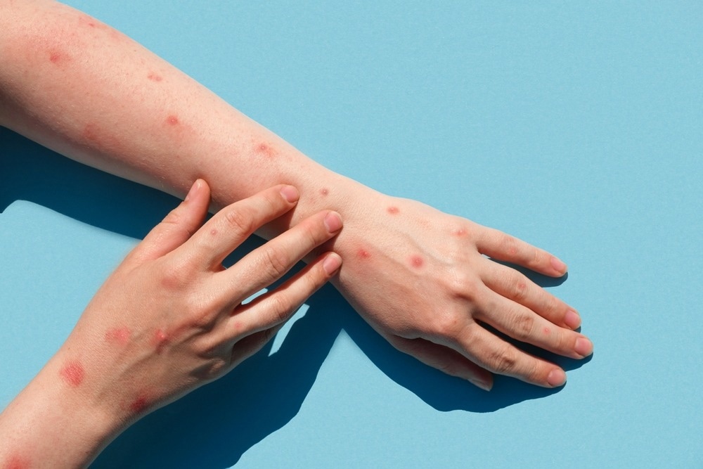 Study: Monkeypox, a Literature Review: What Is New and Where Does This concerning Virus Come From? Image Credit: Marina Demidiuk/Shutterstock