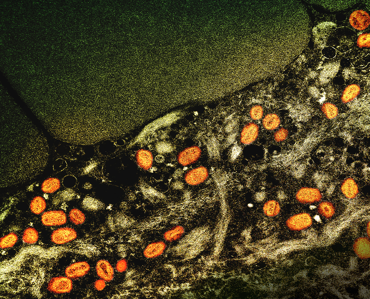 Medical News & Perspectives - Reports of Asymptomatic Monkeypox Suggest That, at the Very Least, Some Infections Go Unnoticed. Image Credit: NIAID