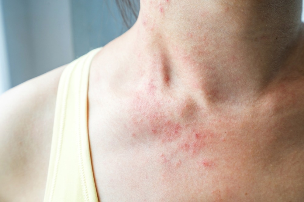 Study: SARS-CoV-2 and Skin: New Insights and Perspectives. Image Credit: kitzcorner/Shutterstock