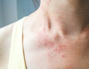 The possible association between SARS-CoV-2, ACE2, TMPRSS2, and skin manifestations