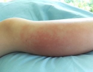 Cellulitis, a deep bacterial infection of the skin, as a monkeypox complication