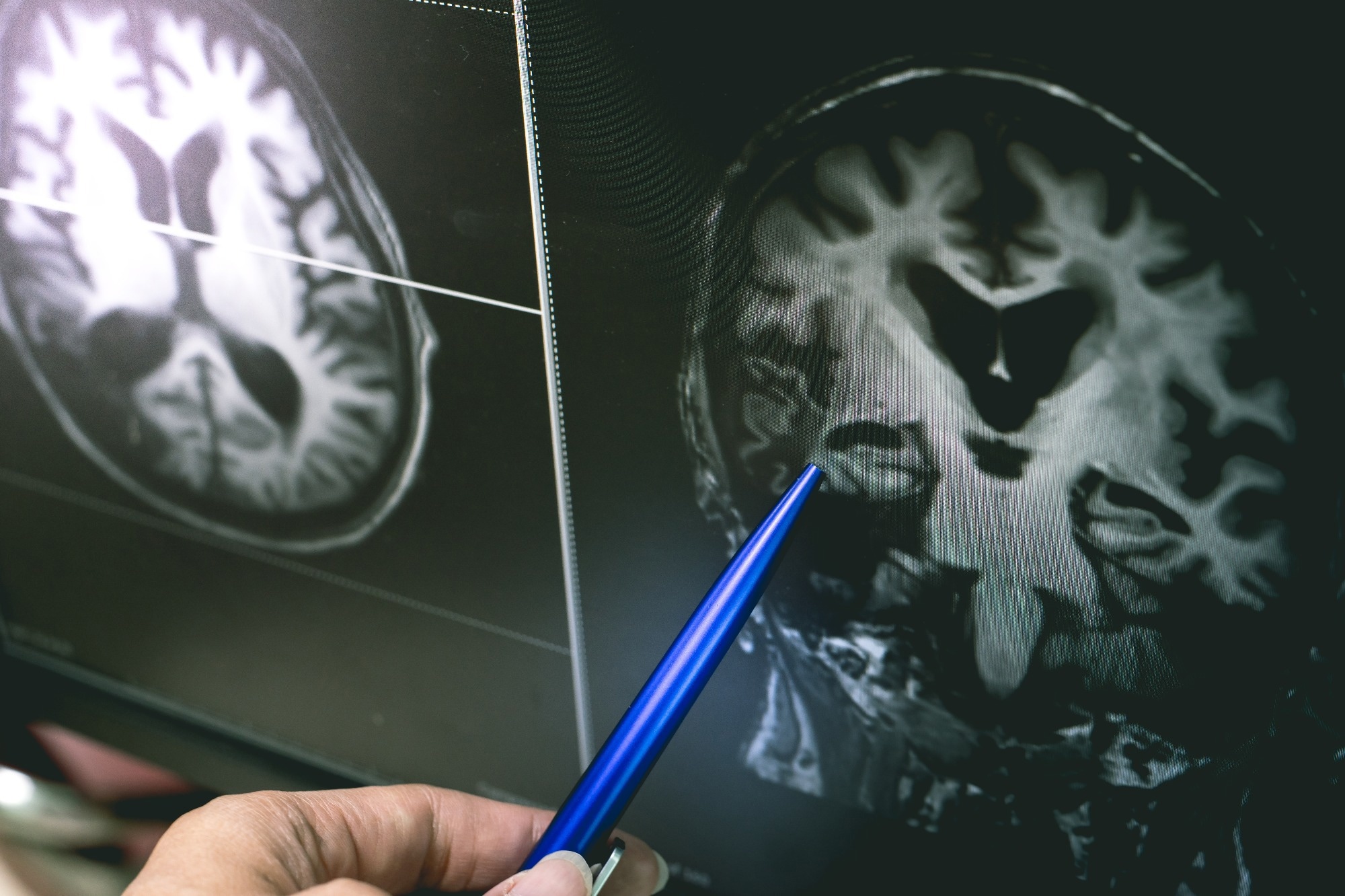 Study: Association between use of systemic and inhaled glucocorticoids and changes in brain volume and white matter microstructure: a cross-sectional study using data from the UK Biobank. Image Credit: Atthapon Raksthaput / Shutterstock