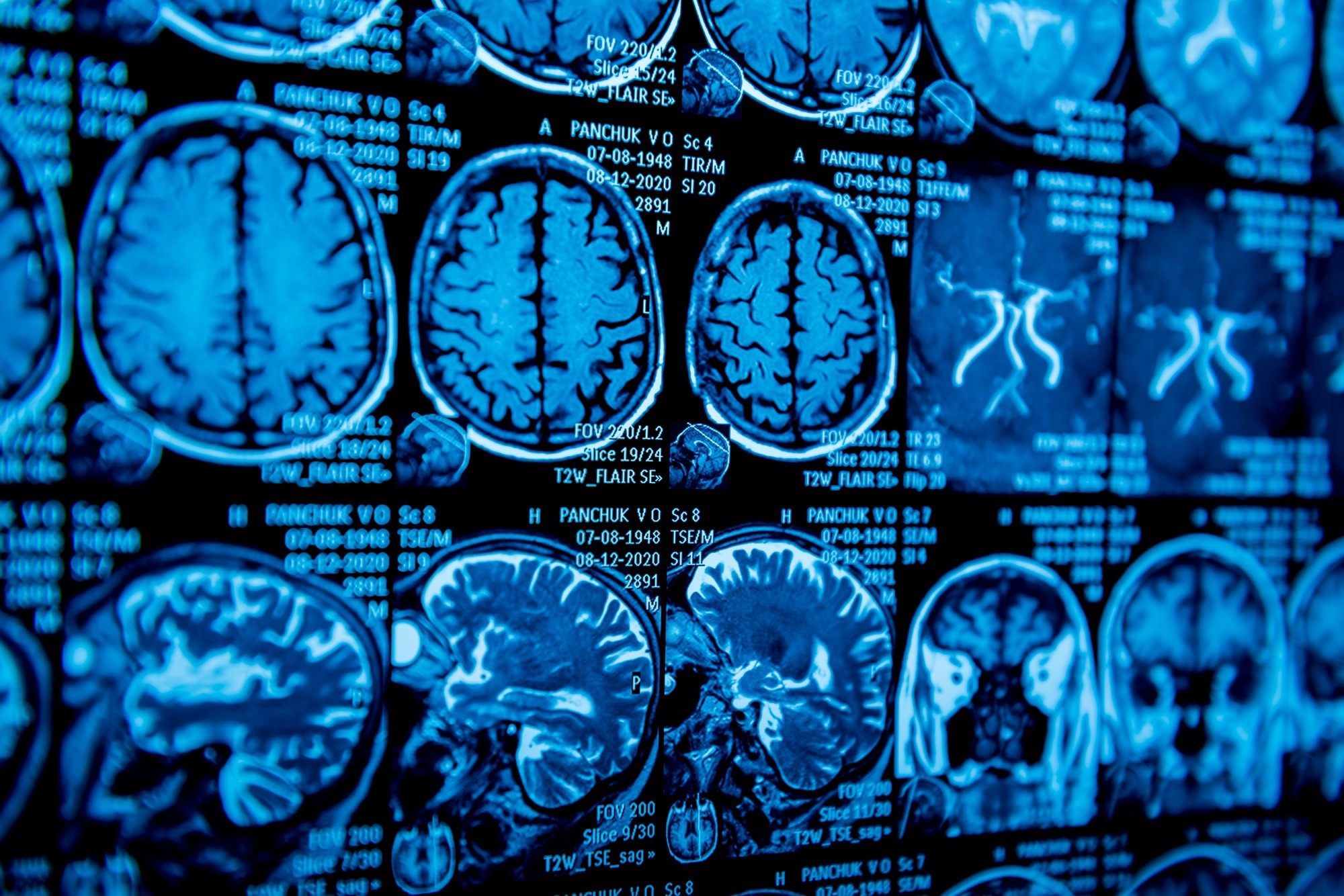 Study: Larger gray matter volumes in neuropsychiatric long-COVID syndrome. Image Credit: Roman Zaiets / Shutterstock