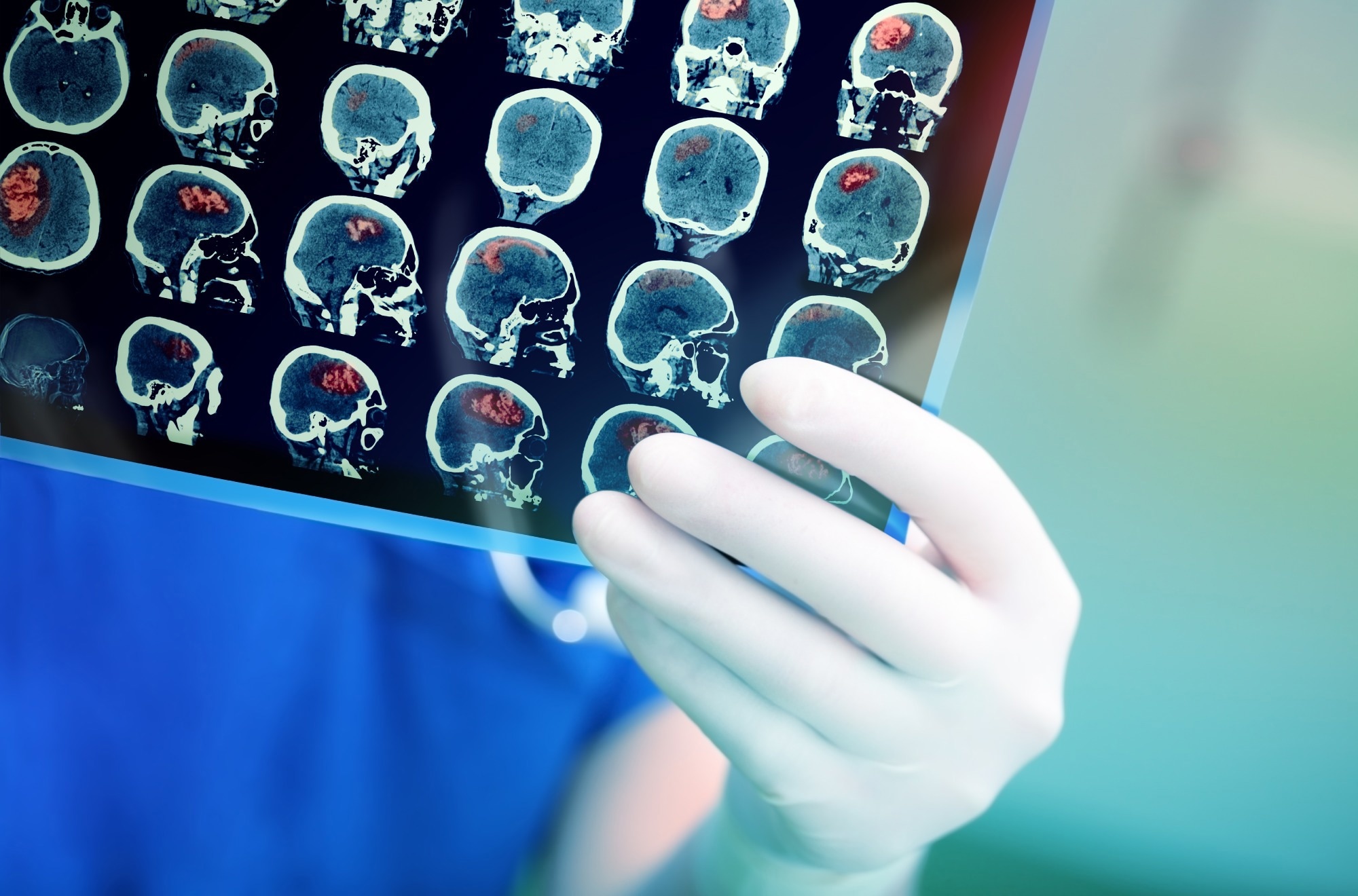 Study: Brain injury in COVID-19 is associated with dysregulated innate and adaptive immune responses. Image Credit: sfam_photo / Shutterstock