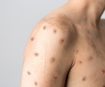 CDC report shows people with monkeypox have higher than expected rates of HIV and STIs