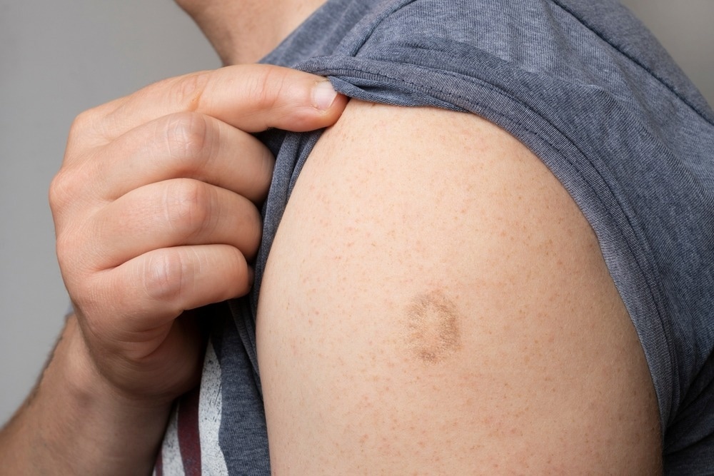 Study: Low levels of monkeypox virus neutralizing antibodies after MVA-BN vaccination in healthy individuals. Image Credit: Cristian Storto/Shutterstock