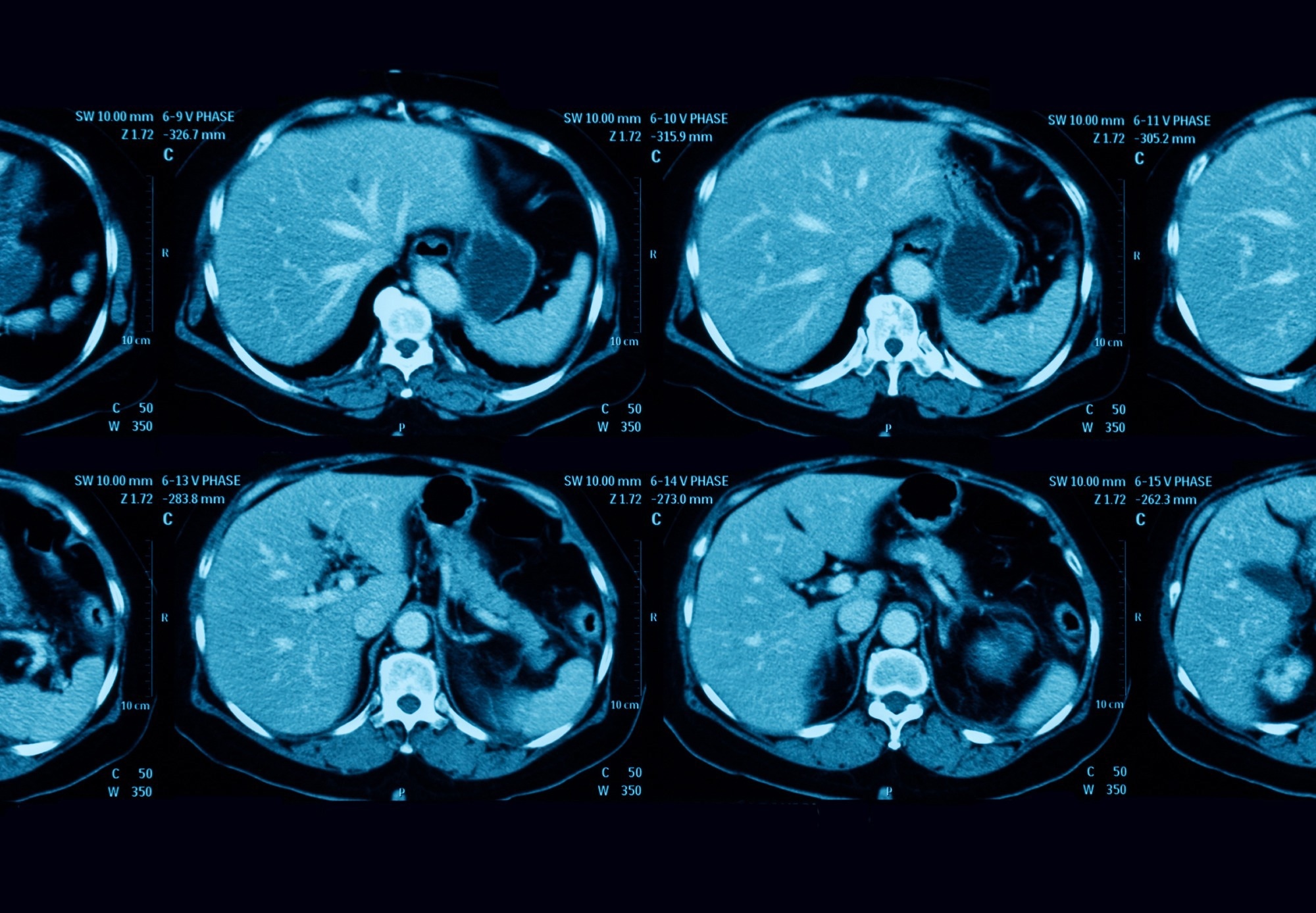 Study: Pancreatic Cancer Detection on CT Scans with Deep Learning: A Nationwide Population-based Study. Image Credit: Suttha Burawonk / Shutterstock
