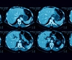 AI used to identify pancreatic cancer in CT scans