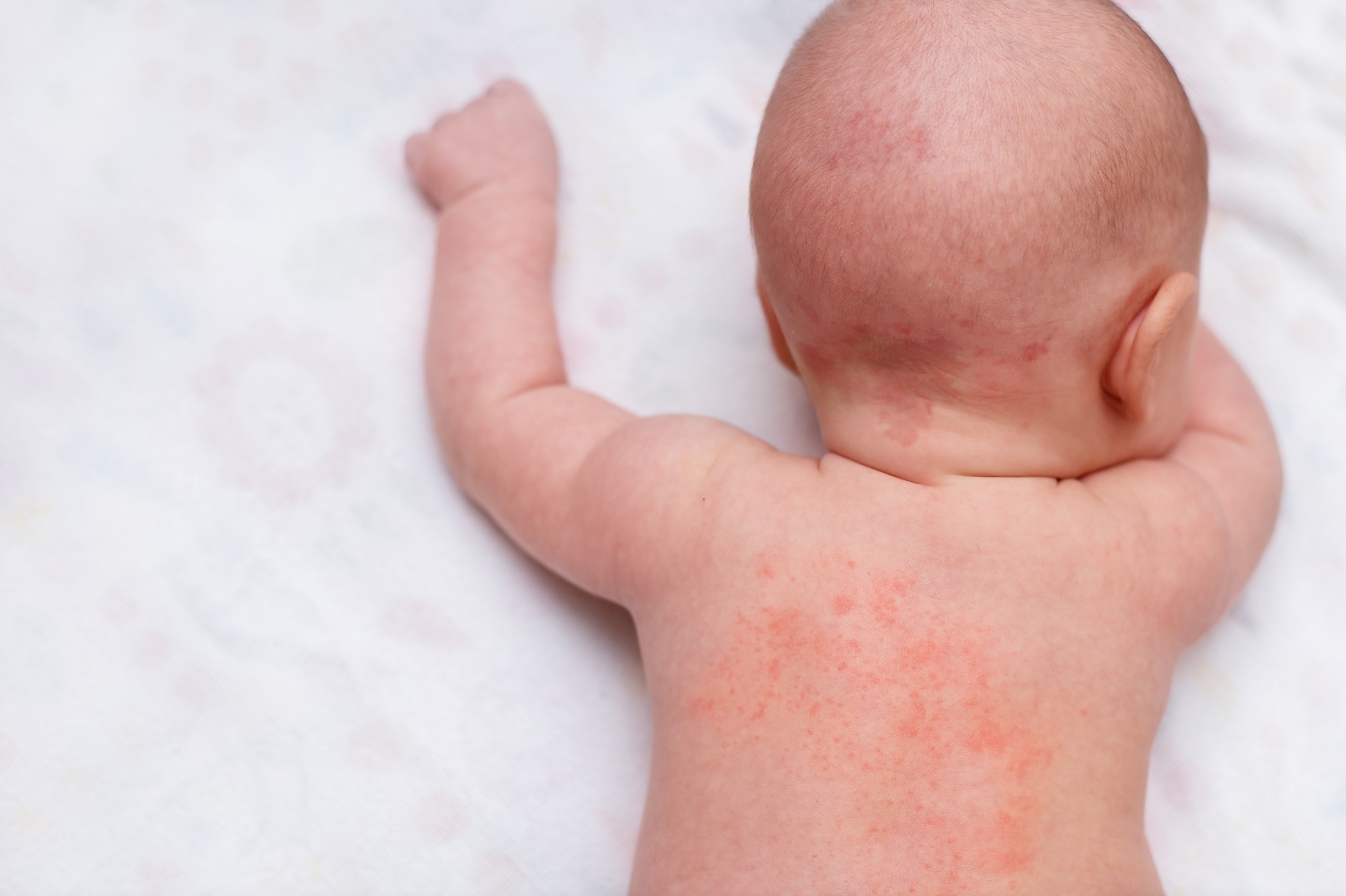 Study: Dupilumab in children aged 6 months to younger than 6 years with uncontrolled atopic dermatitis: a randomised, double-blind, placebo-controlled, phase 3 trial​​​​​​​. Image Credit: Aisylu Ahmadieva / Shutterstock