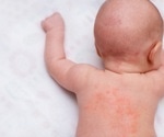 Itchy eczema in children finally gets relief
