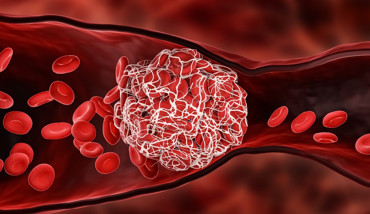 Study: Association of COVID-19 With Major Arterial and Venous Thrombotic Diseases: A Population-Wide Cohort Study of 48 Million Adults in England and Wales. Image Credit: MattLphotography/Shutterstock