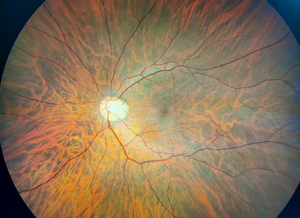 Study: Post-COVID-19 syndrome: retinal microcirculation as a potential marker of chronic fatigue.  Image credit: Monet_3k/Shutterstock