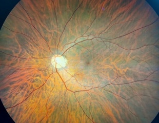 Association of self-reported chronic fatigue and retinal microcirculation in post-COVID-19 syndrome patients