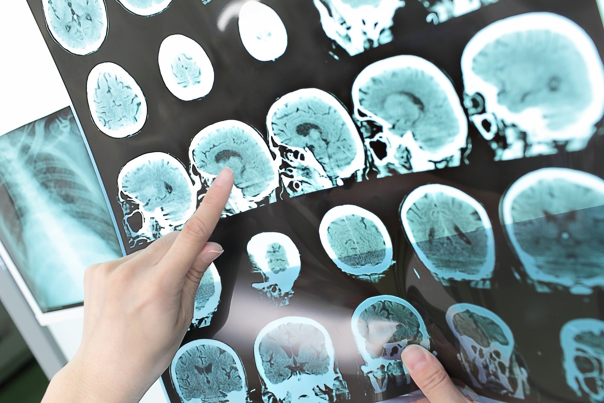 مطالعه: ژنتیک سکته مغزی به کشف دارو و پیش‌بینی خطر در میان اجداد کمک می‌کند.  اعتبار تصویر: sfam_photo/Shutterstock