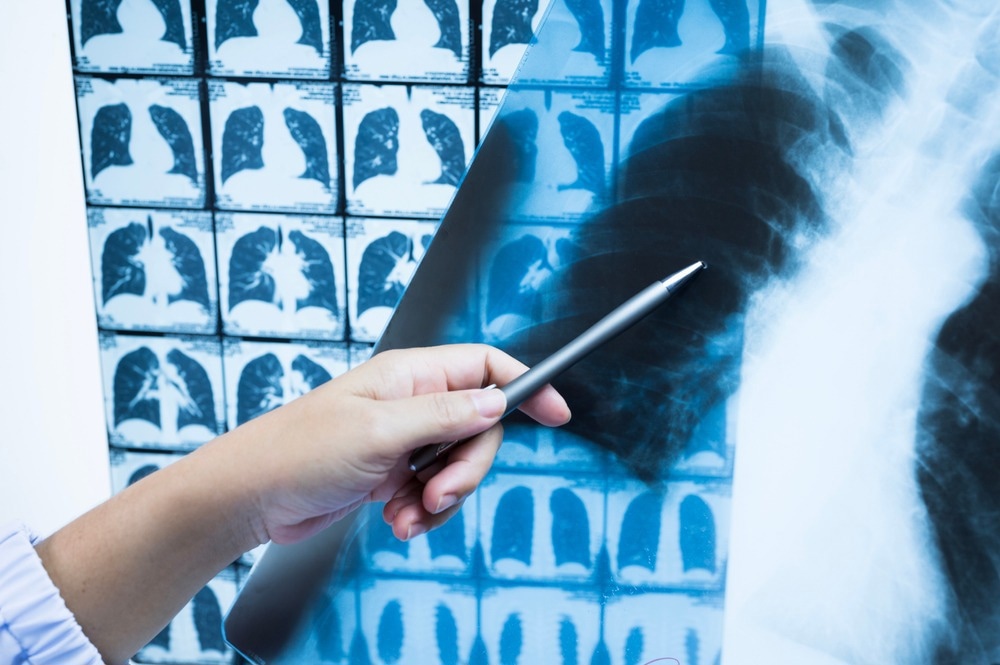 Lung Radiographic Patterns in Patients Diagnosed with SARS-CoV-2 Pneumonia