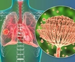 Study presents rare cases of COVID-19-associated pulmonary aspergillosis