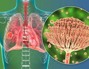 Study presents rare cases of COVID-19-associated pulmonary aspergillosis