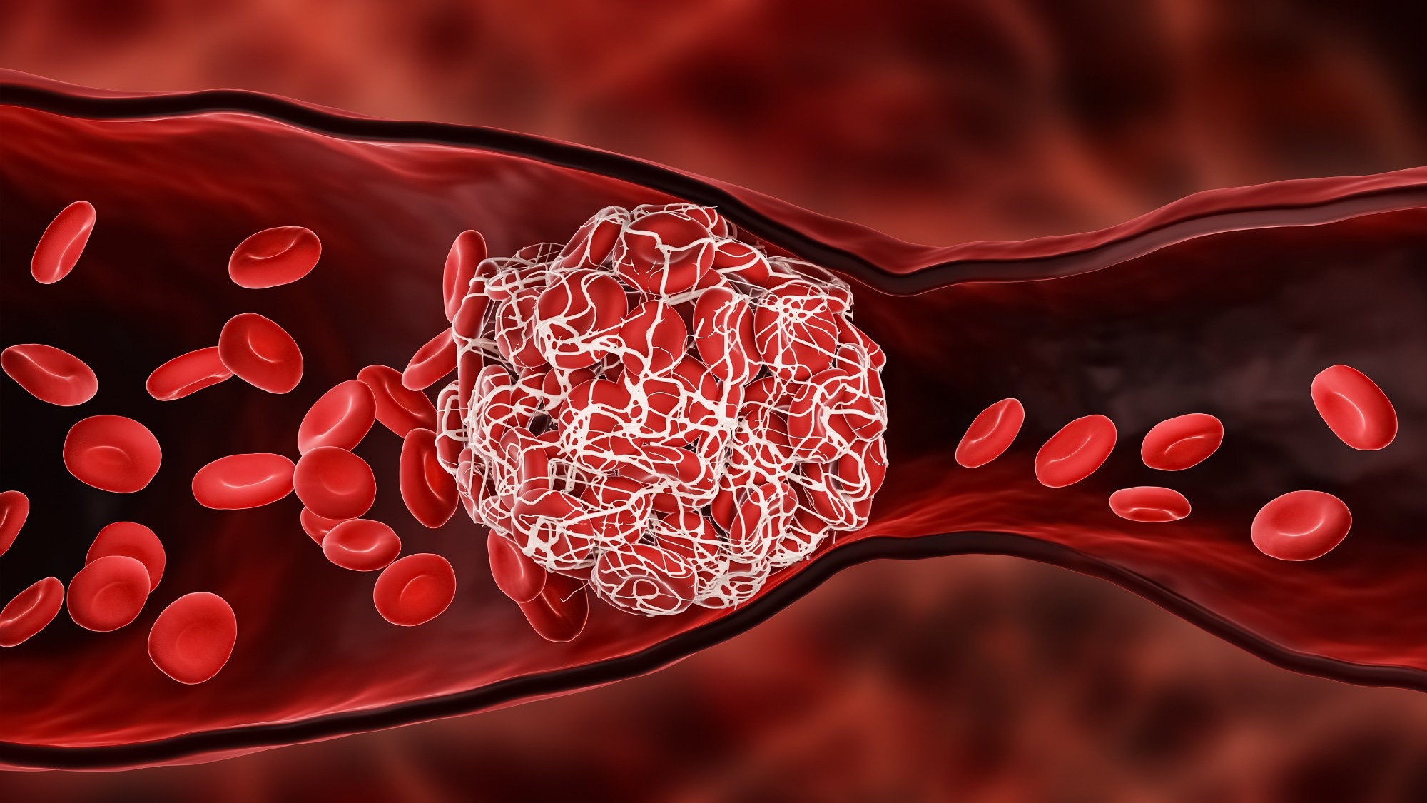 Study: COVID-19 associated coagulopathy and thrombosis in cancer. Image Credit: MattLphotography/Shutterstock