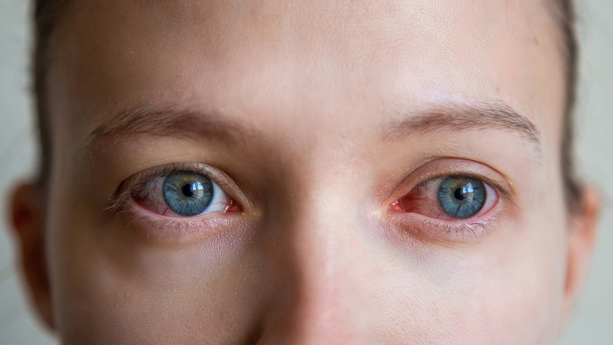 Study: Ocular Monkeypox — United States, July–September 2022. Image Credit: Sakharova Anastasia/Shutterstock
