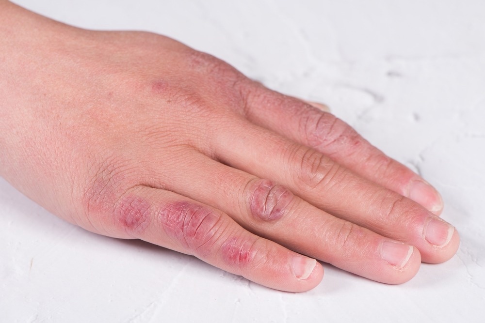 Study: COVID-toes: An ecological study of chilblains and COVID-19 diagnoses in Victoria, Australia. Image Credit: lungfu01 / Shutterstock.com