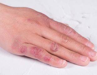 Relationship between COVID-19 and chilblains
