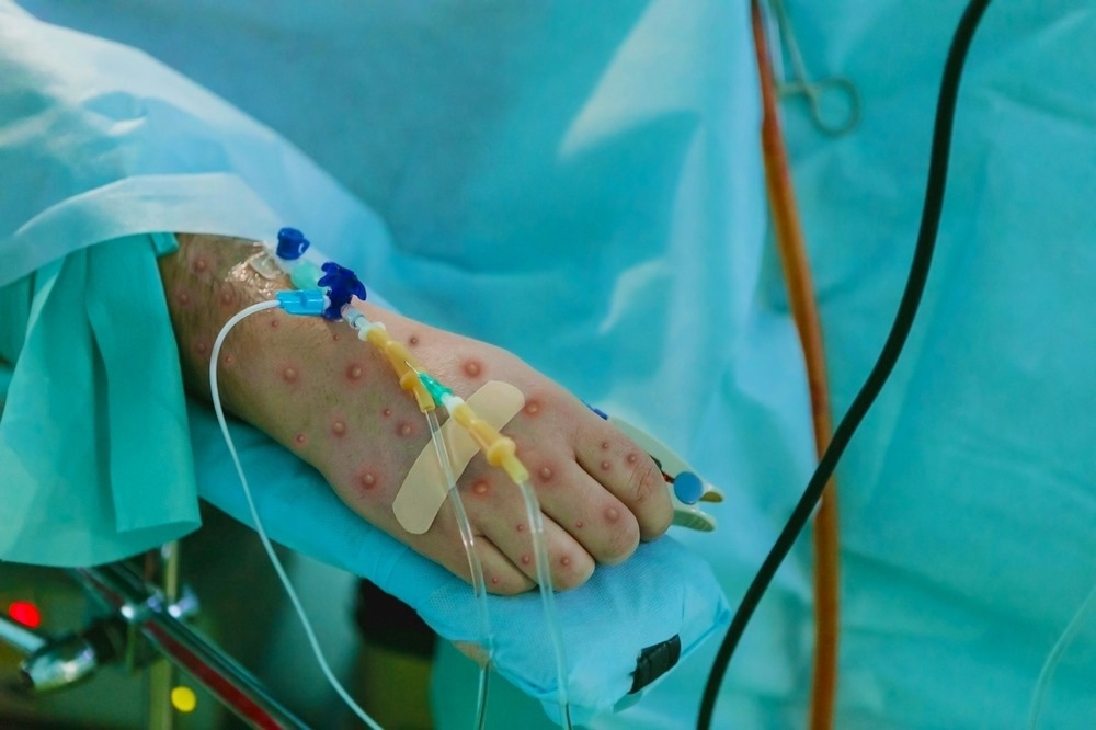 Study: Severe Monkeypox in Hospitalized Patients — United States, August 10–October 10, 2022. Image Credit: Berkay Ataseven / Shutterstock.com