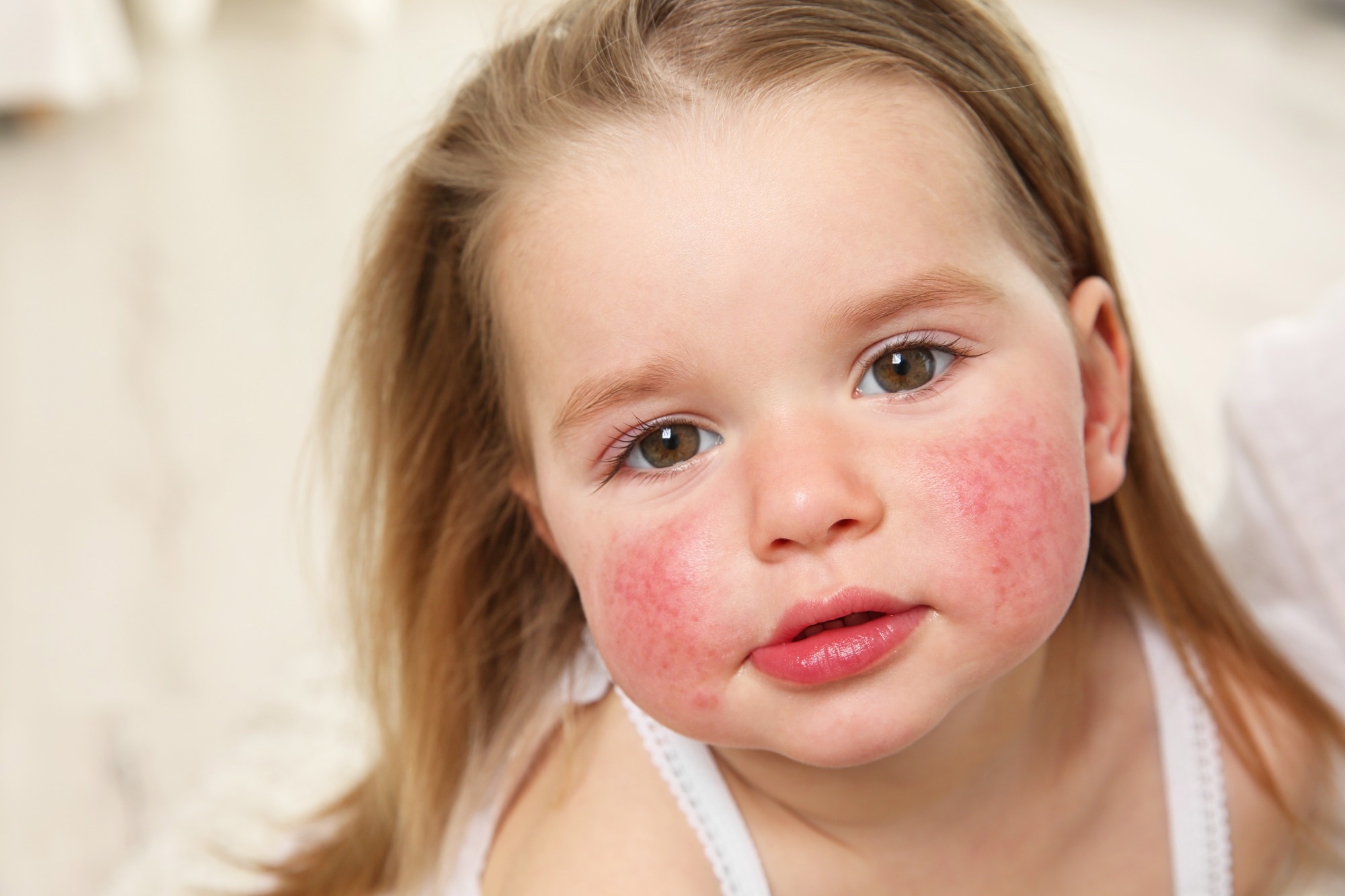Study: Early-life exposure to air pollution associated with food allergy in children: Implications for ‘one allergy’ concept.  Image Credit: Africa Studio / Shutterstock