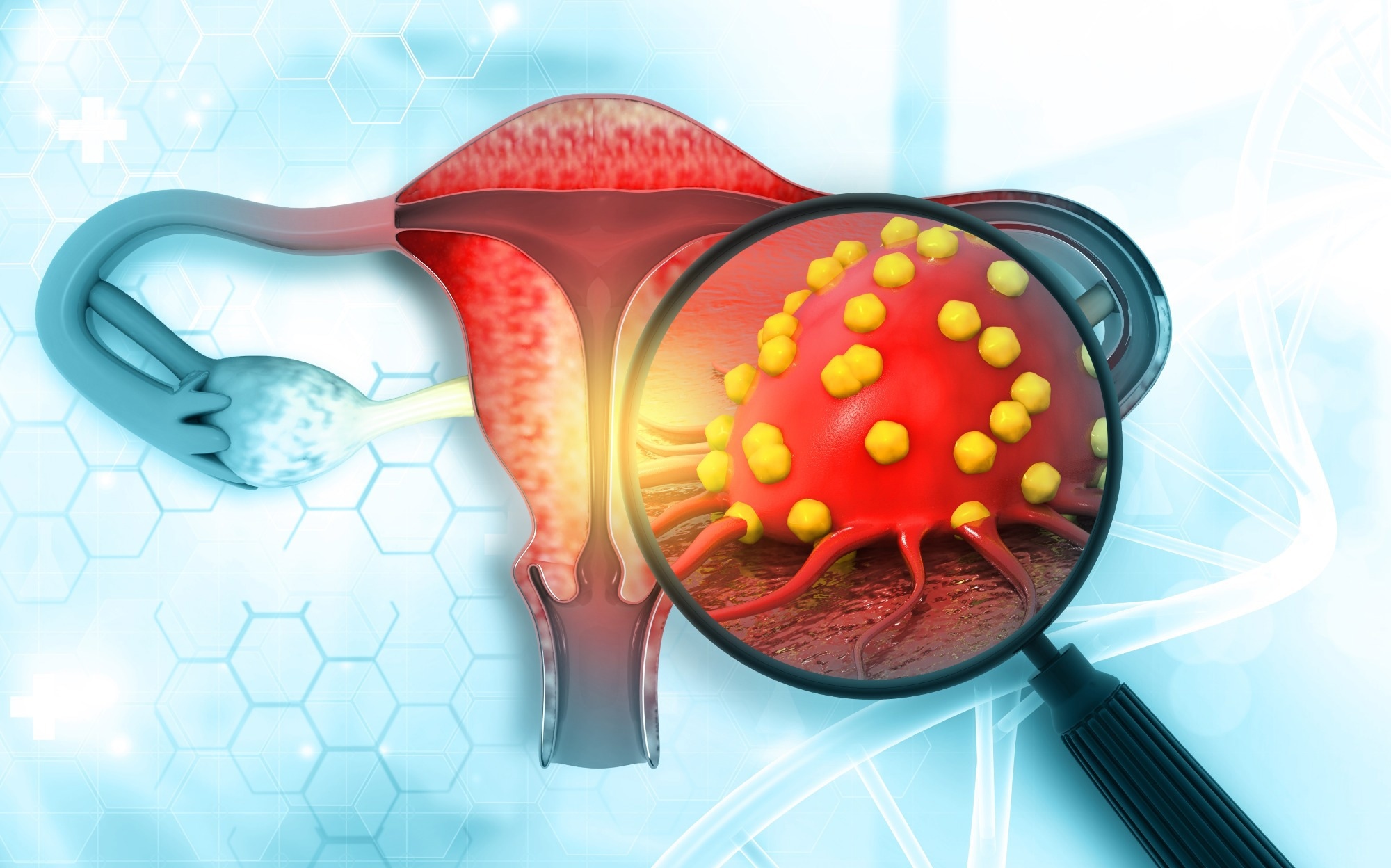 Study: Mendelian randomization analysis of factors related to ovulation and reproductive function and endometrial cancer risk. Image Credit: crystal light / Shutterstock