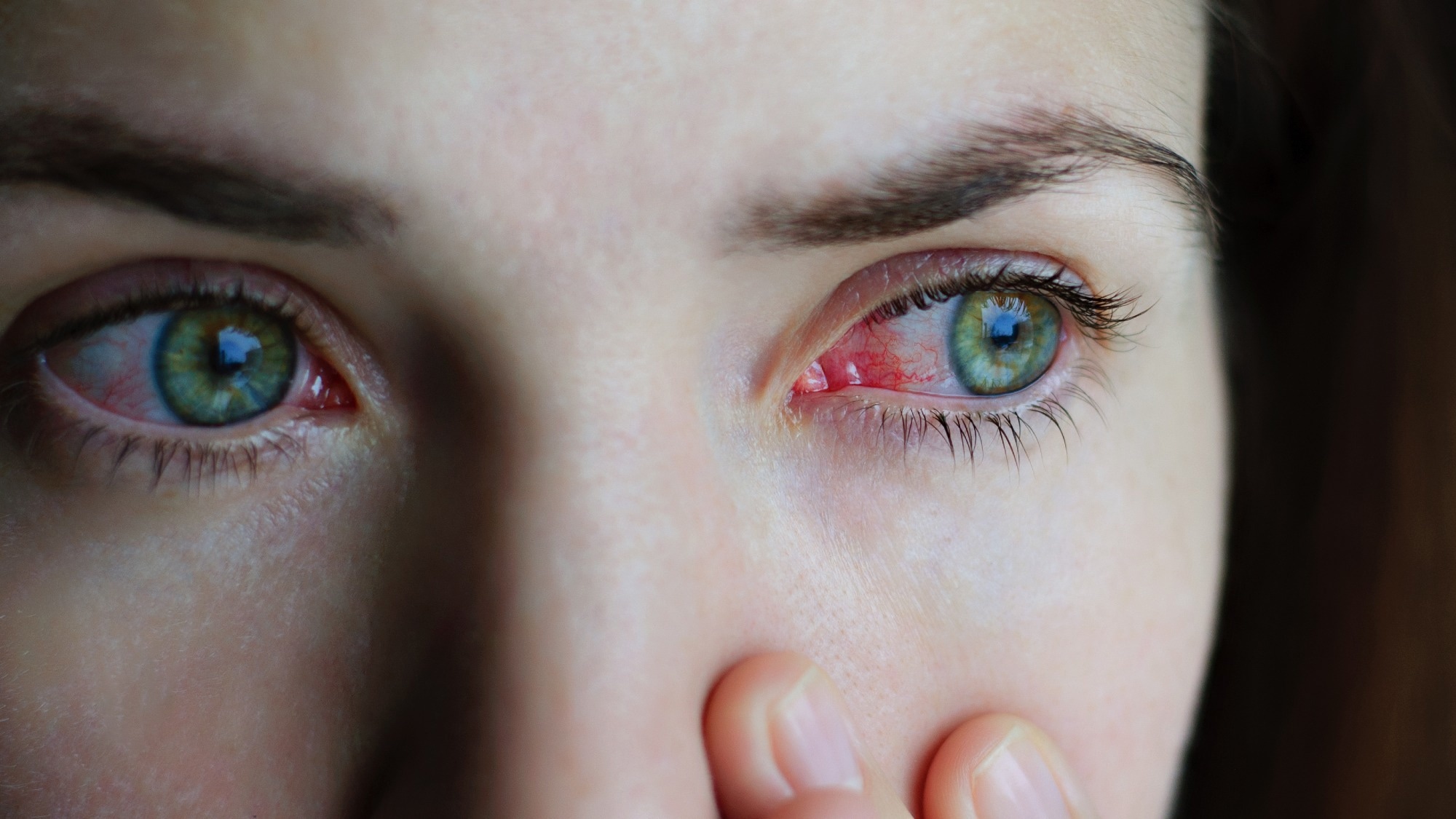 Study: Monkeypox and ocular implications in humans. Image Credit: Domaskina/Shutterstock