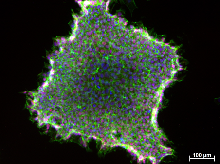 Induced Pluripotent Stem Cells (IPSCs) derived from jaw periosteal cells. NANOG (pluripotency marker) – red, F-actin (cytoskeleton) – green, cell nuclei – blue.