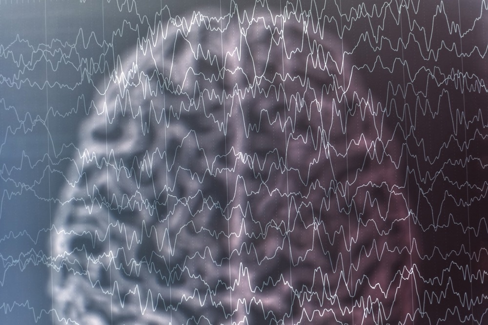 Study: Incidence of Epilepsy and Seizures Over the First 6 Months After a COVID-19 Diagnosis: A Retrospective Cohort Study. Image Credit: Chaikom / Shutterstock.com