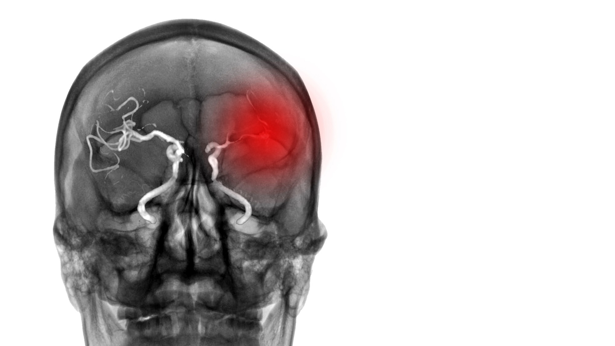Study: SARS-CoV-2 Infection and Increased Risk for Pediatric Stroke. Image Credit: joel bubble ben/Shutterstock