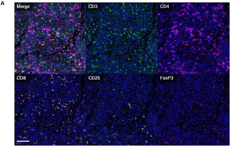 تشخیص سلول های T حافظه مقیم بافت در تومورهای جامد