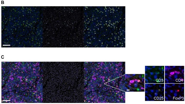 تشخیص سلول های T حافظه مقیم بافت در تومورهای جامد