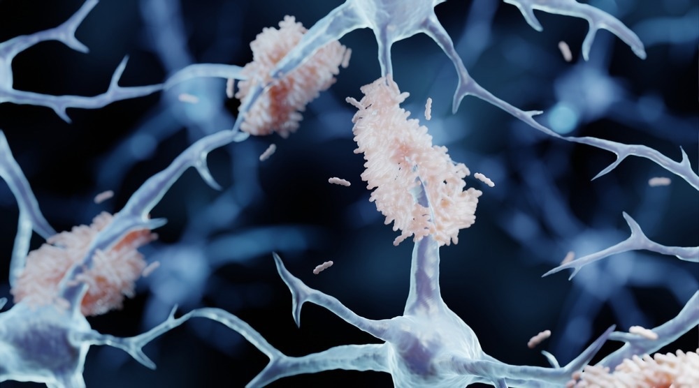 مطالعه: ارتباط سطوح پروتئین کلوتو و هتروزیگوسیتی KL-vs با آلزایمر