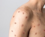 Monkeypox renamed "mpox" in an effort to combat stigma