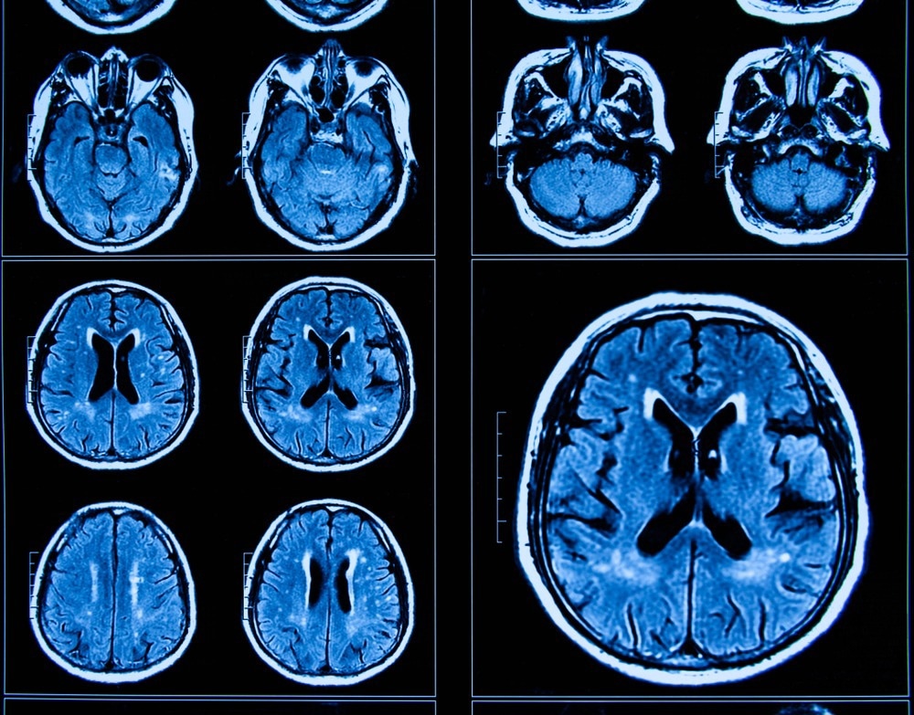 COVID-19 pandemic caused rapid brain aging in adolescents