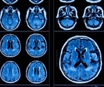 COVID-19 pandemic caused rapid brain aging in adolescents