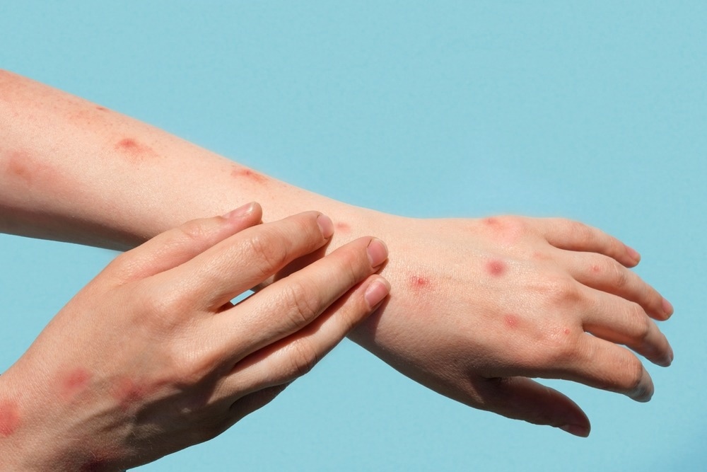 Study: Mpox (formerly monkeypox) in women: epidemiological features and clinical characteristics of mpox cases in Spain, April to November 2022. Image Credit: Marina Demidiuk/Shutterstock