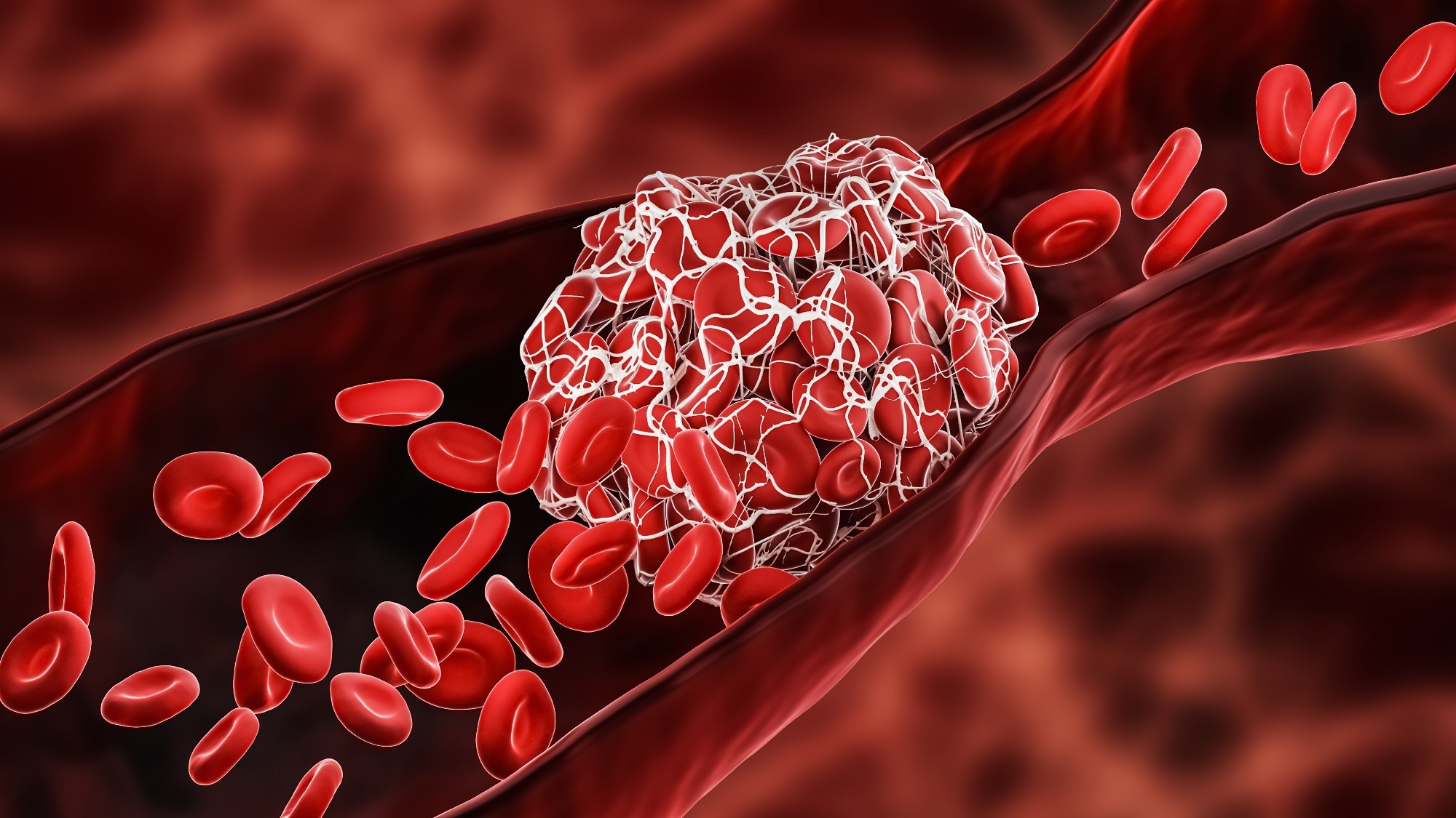 Study: The potential impact of nanomedicine on COVID-19-induced thrombosis. Image Credit: MattLphotography/Shutterstock