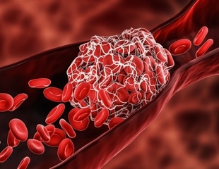 Review on nanoparticles usage for treating thrombosis induced by SARS-CoV-2 infections