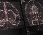 AI won't replace radiologists, yet!