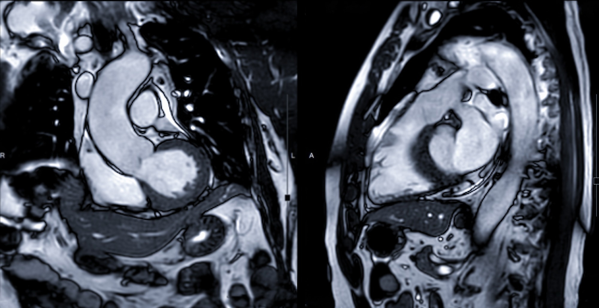 Étude : Résultats de l'IRM cardiaque chez les patients COVID-19 aigus et post-aigus avec une myocardite suspectée.  Crédit d'image : Image radiologique/Shutterstock