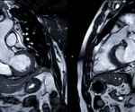 Cardiac MRI of individuals with acute or post-acute COVID-19