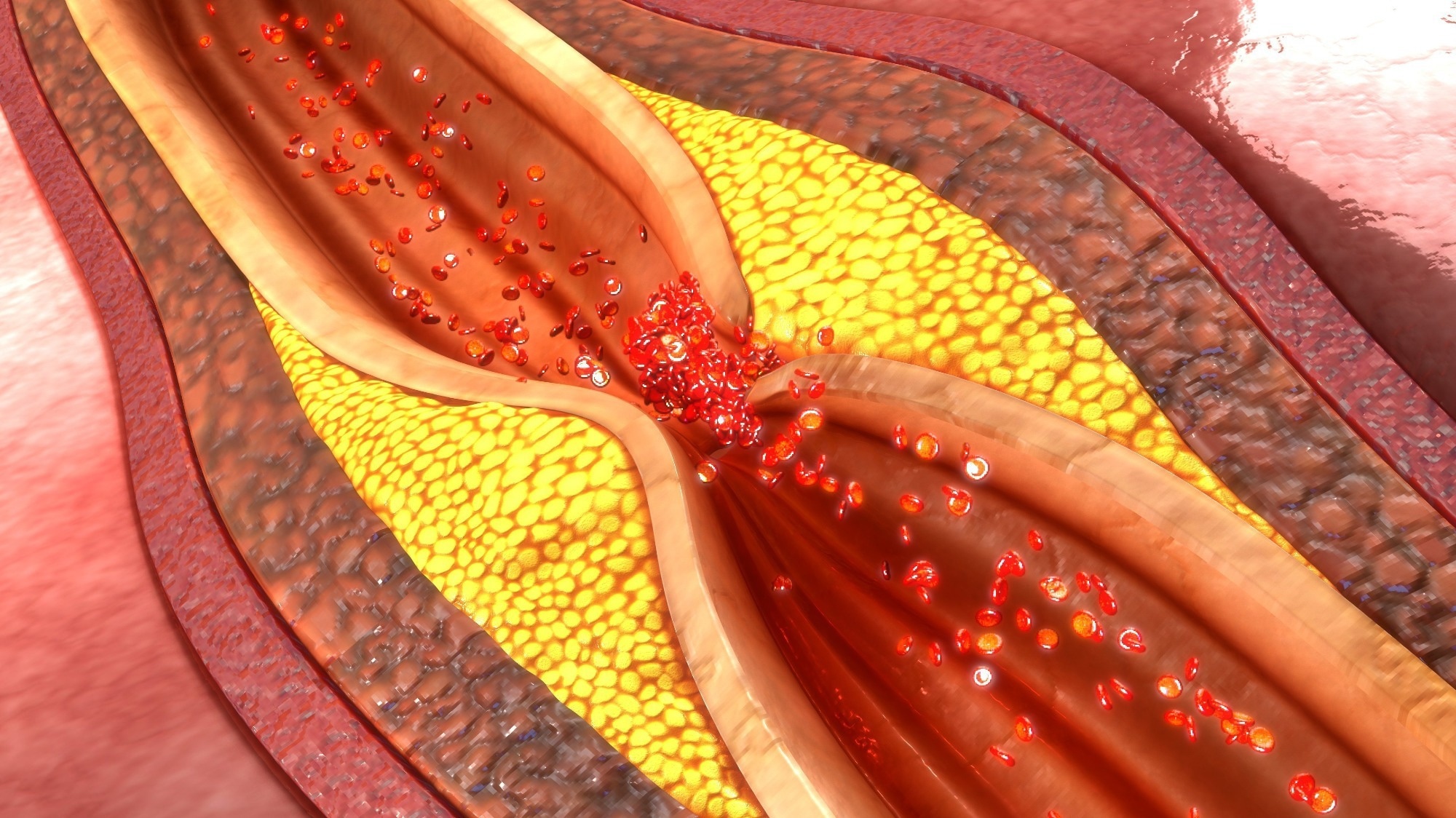 Study: Exercise volume versus intensity and progression of coronary atherosclerosis in middle-aged and older athletes: findings from the MARC-2 study.  Image Credit: sciencepics / Shutterstock