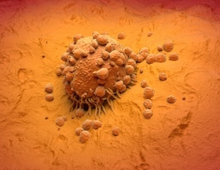 Metastatic Melanoma: key protein identified that aids the spread of skin cancer