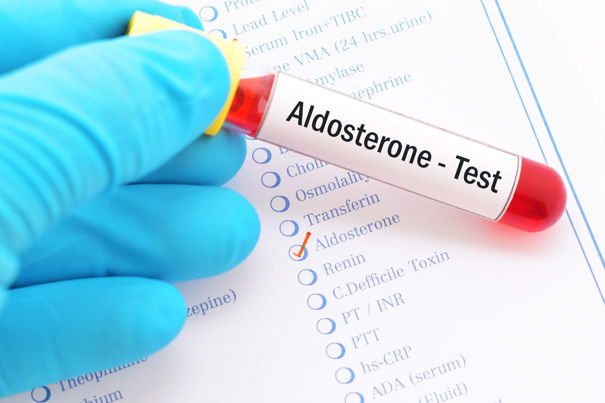 Study: [11C]metomidate PET-CT versus adrenal vein sampling for diagnosing surgically curable primary aldosteronism: a prospective, within-patient trial. Image Credit: Jarun Ontakrai/Shutterstock