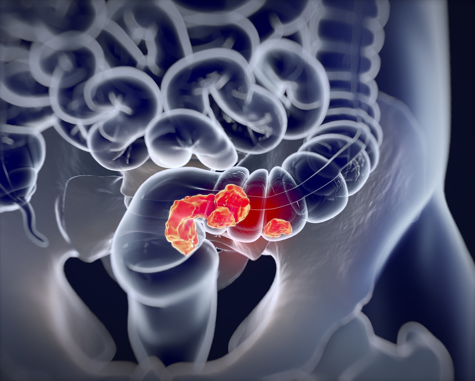 Study: Multiplexed 3D atlas of state transitions and immune interaction in colorectal cancer. Image Credit: Anatomy Image/Shutterstock