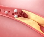 Non-esterified fatty acid levels correlate with peripheral artery disease risk
