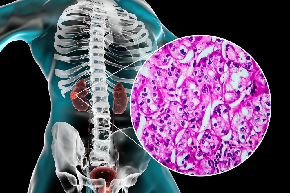 Study: A New Treatment Landscape for RCC: Association of the Human Microbiome with Improved Outcomes in RCC. Image Credit: Kateryna Kon/Shutterstock